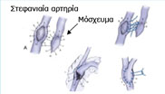 Τεχνική συρραφής ενός μοσχεύματος σε μια στεφανιαία αρτηρία