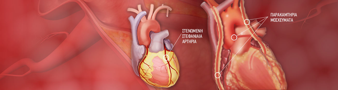 Στεφανιαία Νόσος